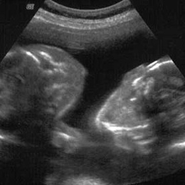 Image:3d ultrasound