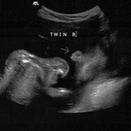 ultrasound of Caleb